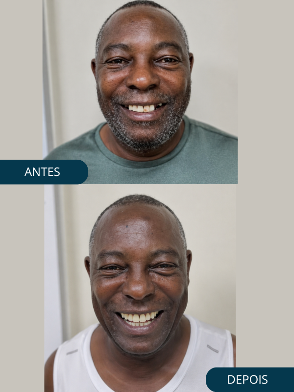 Antes e Depois - Odonto Help
